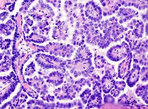 CancerRes：新研究发明资助扫除癌症干细胞的新靶标