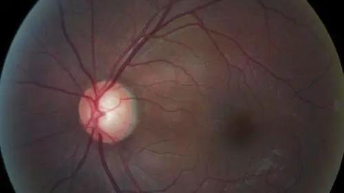 青光眼的克星来袭，，，助力患者远离视力的“窃贼”