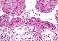 【Science速递】“默然的杀手”卵巢癌的治疗新靶点终于被发明了