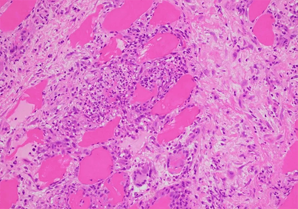 【新宝GG助力】治疗结节病的KBMAB-16获FDA批准临床